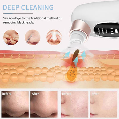 Blackhead Remover w Review by Reem Al Falasi