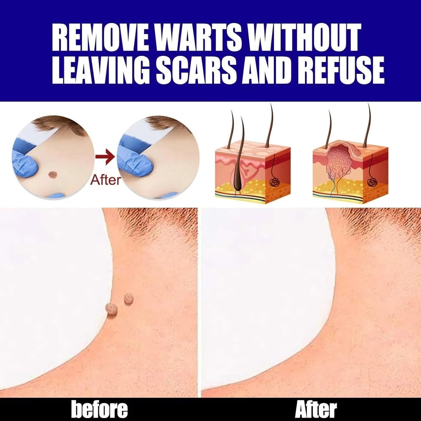 Fast & Effective Warts Remover | Natural Skin Care Formula